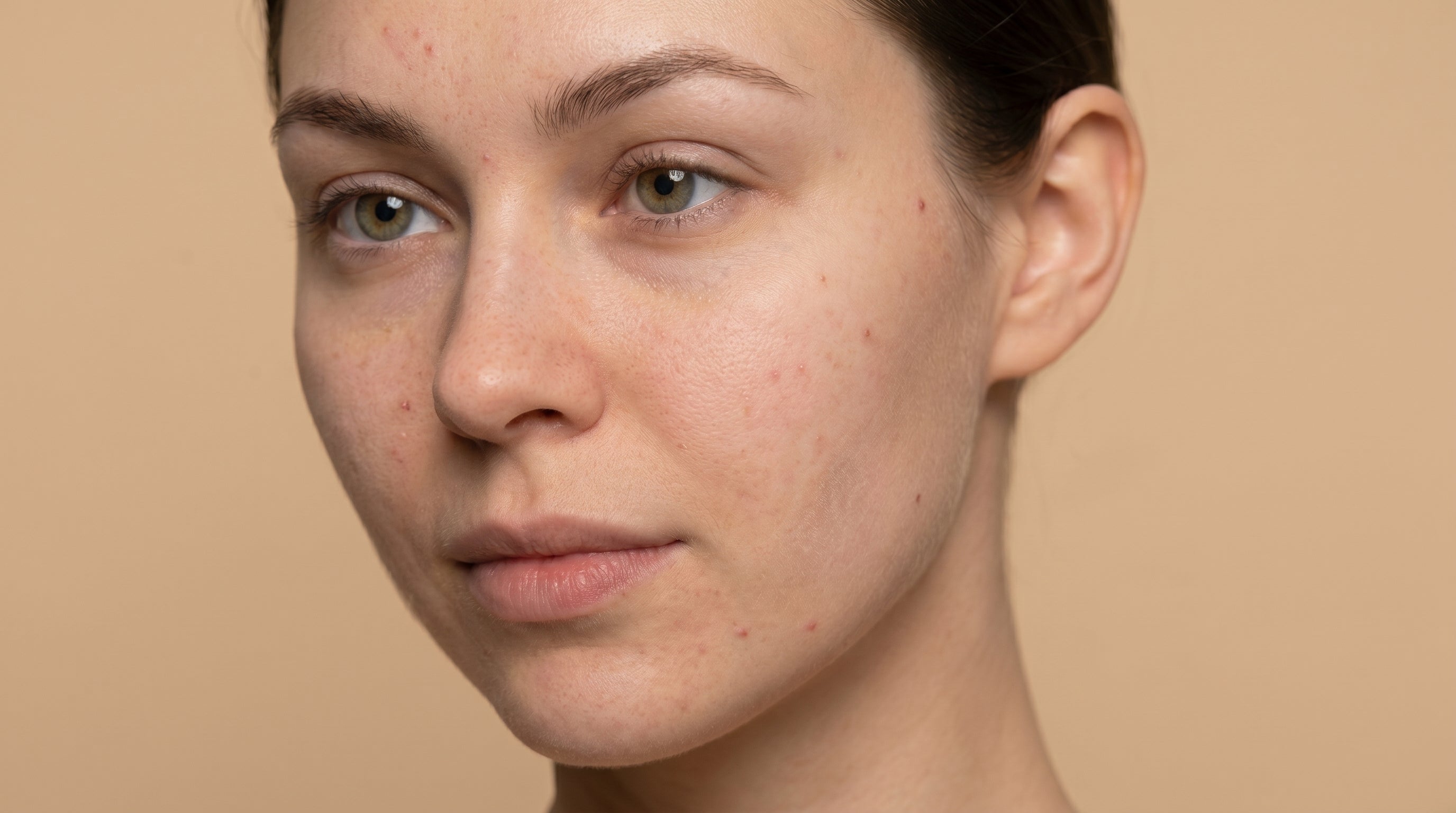 Primer plano del rostro de una mujer antes de comenzar el tratamiento con Aceite de Rosa Mosqueta de Amanitas. Imagen que muestra la textura natural de la piel con pequeñas marcas, utilizada como referencia inicial para demostrar el poder regenerador y reparador del aceite botánico.